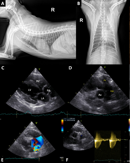 진단 당시 CT 영상, 우측 폐동맥 가지의 협착 (*) 소견이 확인되며, 후방 폐동맥은 협착으로 인해 post-stenotic dilatation 소견이 확인된다. (흰색 화살표) 이에 반해 좌측 폐동맥 가지는 매우 얇게 저형성 (파란 화살표) 되어 있으며 폐동맥으로 혈관이 이어지지 않고 tapering 되어 소실된다.