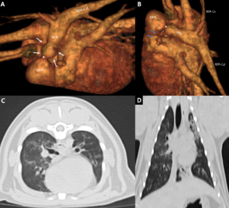 진단 당시 CT 영상, 우측 폐동맥 가지의 협착 (*) 소견이 확인되며, 후방 폐동맥은 협착으로 인해 post-stenotic dilatation 소견이 확인된다.